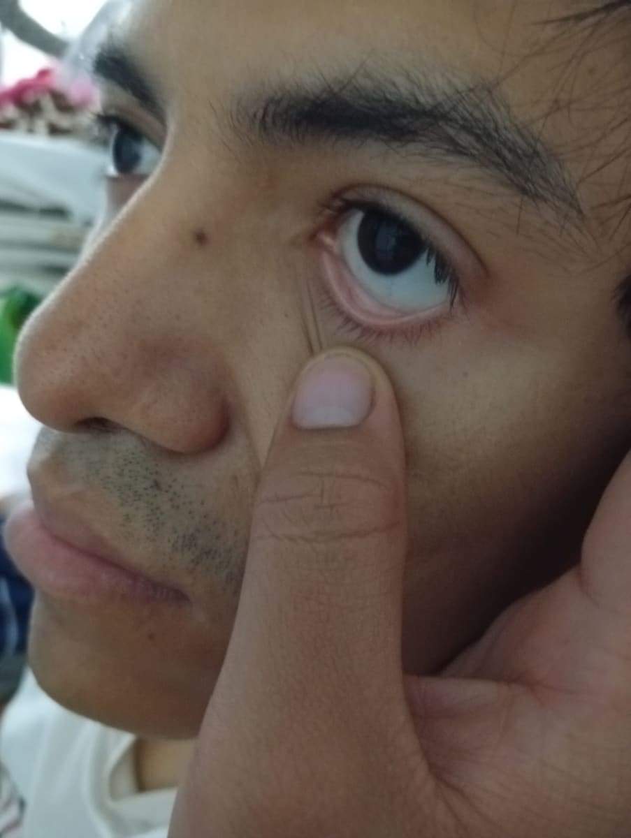 Primer plano del ojo de Joseph mostrando palidez por la anemia