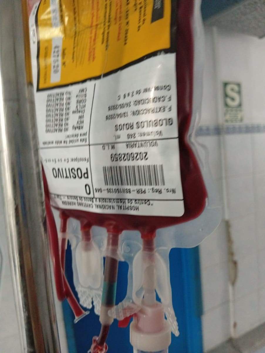 Bolsa de glóbulos rojos para transfusión colgada de un poste