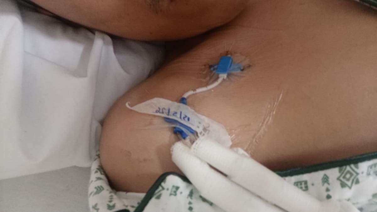Catéter colocado en el pecho de Joseph